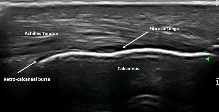 Achillies Tendon Ultrasound Bozeman MT