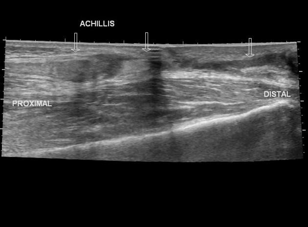 Musculoskeletal Ultrasound Bozeman MT