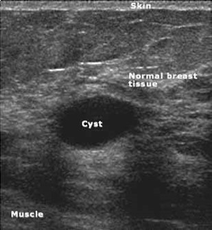 Breast Ultrasound Bozeman MT