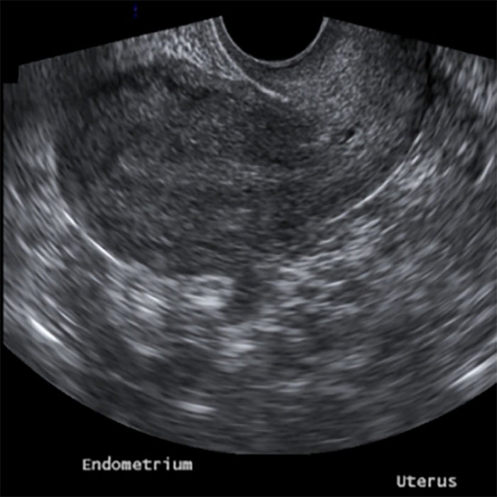 Gynecologic Pelvic Ultrasound Bozeman MT