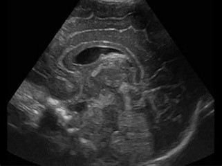 Pediatric Ultrasound Bozeman MT
